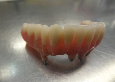 Υβριδική Αποκατάσταση