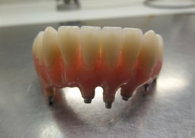 Υβριδική Αποκατάσταση