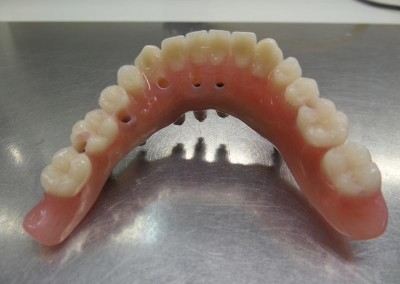 Υβριδική Αποκατάσταση