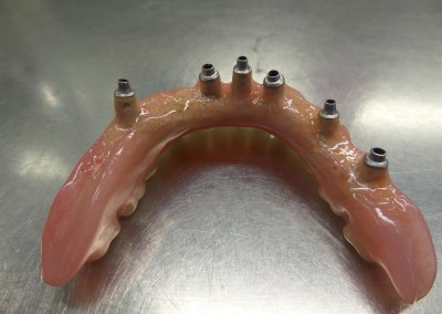 Υβριδική Αποκατάσταση