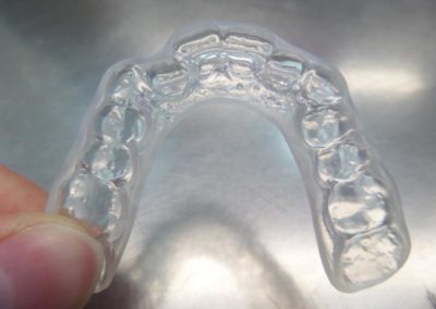 Νάρθηκας Βρουξισμού