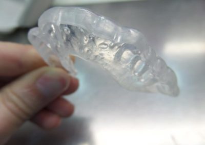 Νάρθηκας Βρουξισμού