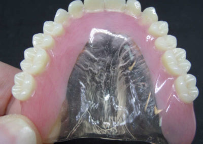 Οδοντοστοιχία Άνω Γνάθου με Διαφανή Υπερώα