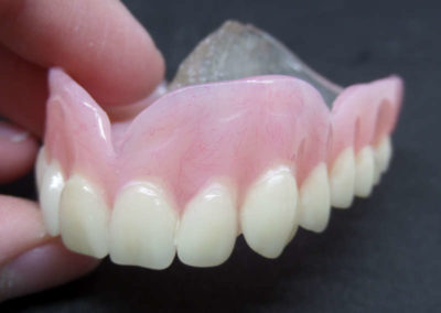 Οδοντοστοιχία Άνω Γνάθου με Διαφανή Υπερώα