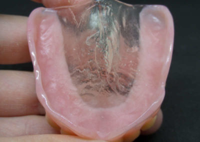 Οδοντοστοιχία Άνω Γνάθου με Διαφανή Υπερώα