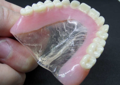 Οδοντοστοιχία Άνω Γνάθου με Διαφανή Υπερώα