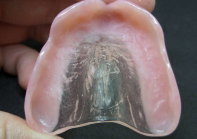 Οδοντοστοιχία Άνω Γνάθου με Διαφανή Υπερώα