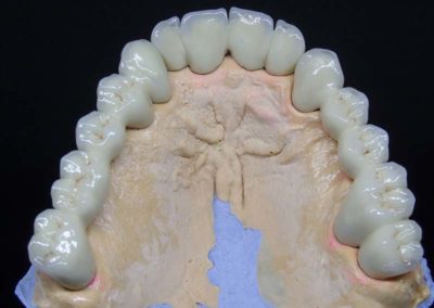 Πλήρης Μεταλλοκεραμική Αποκατάσταση Άνω Γνάθου