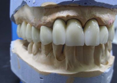 Πλήρης Μεταλλοκεραμική Αποκατάσταση Άνω Γνάθου