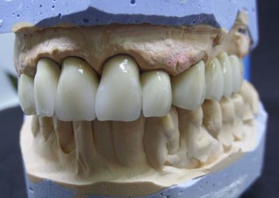 Πλήρης Μεταλλοκεραμική Αποκατάσταση Άνω Γνάθου