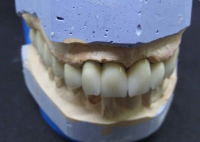 Πλήρης Μεταλλοκεραμική Αποκατάσταση Άνω Γνάθου