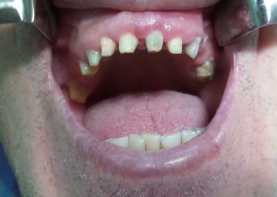 Πλήρης Μεταλλοκεραμική Αποκατάσταση Άνω Γνάθου