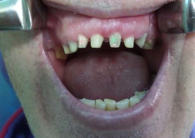 Πλήρης Μεταλλοκεραμική Αποκατάσταση Άνω Γνάθου