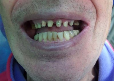 Πλήρης Μεταλλοκεραμική Αποκατάσταση Άνω Γνάθου