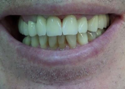 Πλήρης Μεταλλοκεραμική Αποκατάσταση Άνω Γνάθου