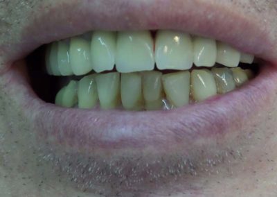 Πλήρης Μεταλλοκεραμική Αποκατάσταση Άνω Γνάθου