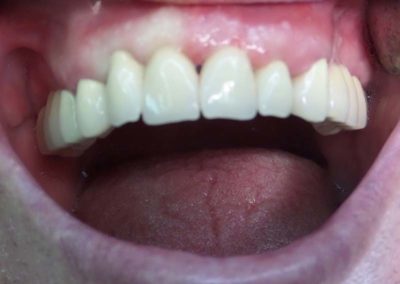 Πλήρης Μεταλλοκεραμική Αποκατάσταση Άνω Γνάθου