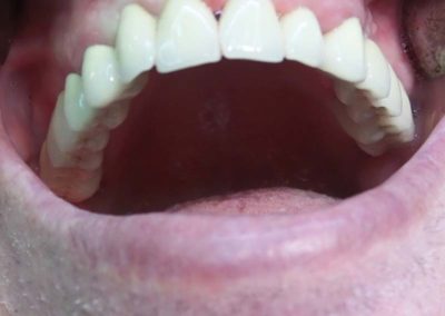 Πλήρης Μεταλλοκεραμική Αποκατάσταση Άνω Γνάθου