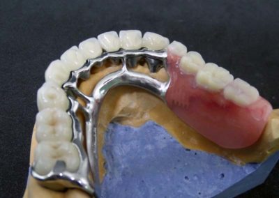 Μεταλλοκεραμική Αποκατάσταση με Μερική Οδοντοστοιχία