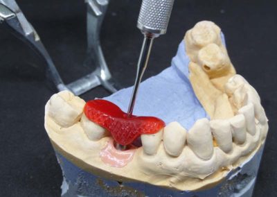 Αποκατάσταση Γομφίου Κάτω Γνάθου με Τοποθέτηση Εμφυτεύματος