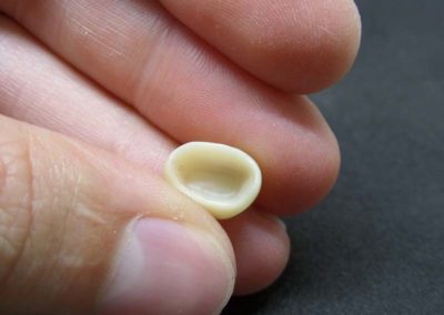 Προγόμφιος Άνω Γνάθου Ολοκεραμικό